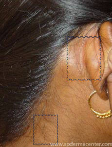 Vitiligo-After